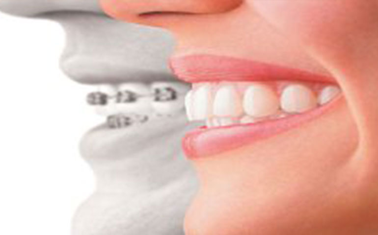 Burhan Demirel Düzce Diş Doktoru Braket Çeşitleri