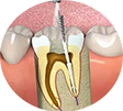 Burhan Demirel Düzce Diş Doktoru Endodonti Kanal Tedavisi